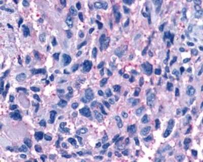 Immunohistochemistry-Paraffin: P2Y11/P2RY11 Antibody [NLS867] - Analysis of anti-P2RY11 / P2Y11 antibody with human brain, glioblastoma.