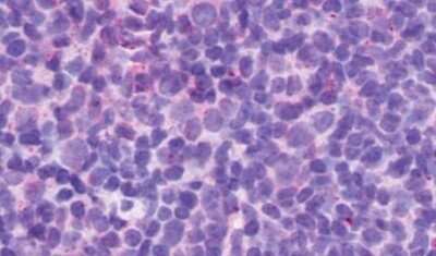 Immunohistochemistry-Paraffin: P2Y13/P2RY13/GPR86 Antibody [NLS1619] - Anti-P2Y13 / P2RY13 antibody IHC of human Lymph Node, Non-Hodgkins Lymphoma. Immunohistochemistry of formalin-fixed, paraffin-embedded tissue after heat-induced antigen retrieval.