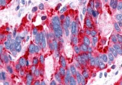 Immunohistochemistry-Paraffin: P2Y13/P2RY13/GPR86 Antibody [NLS1619] - Anti-P2Y13 / P2RY13 antibody IHC of human Stomach, Adenocarcinoma. Immunohistochemistry of formalin-fixed, paraffin-embedded tissue after heat-induced antigen retrieval.