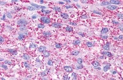 Immunohistochemistry-Paraffin: P2Y13/P2RY13/GPR86 Antibody [NLS1620] - Anti-P2Y13 / P2RY13 antibody IHC of human Brain, Glioblastoma. Immunohistochemistry of formalin-fixed, paraffin-embedded tissue after heat-induced antigen retrieval.