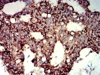 Immunohistochemistry-Paraffin: P2Y14/GPR105 Antibody (8A11B11) [NBP2-61754] - Analysis of colon cancer tissues using P2RY14 mouse mAb with DAB staining.