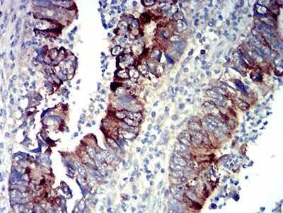 Immunohistochemistry-Paraffin: P2Y14/GPR105 Antibody (8A11B11) [NBP2-61754] - Analysis of rectum cancer tissues using P2RY14 mouse mAb with DAB staining.