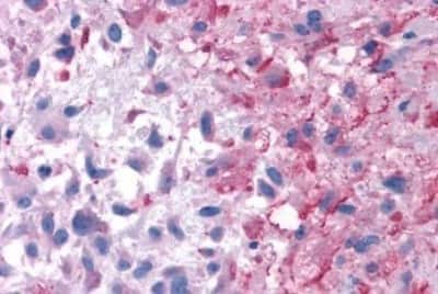 Immunohistochemistry-Paraffin: P2Y14/GPR105 Antibody [NBP3-14438] - Immunohistochemistry of formalin-fixed, paraffin-embedded human brain, glioblastoma, after heat-induced antigen retrieval.