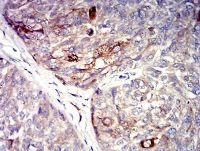 Immunohistochemistry: P2Y4/P2RY4 Antibody (3B4C11) [NBP2-61759] - Analysis of paraffin-embedded bladder cancer tissues using P2RY4 mouse mAb with DAB staining.