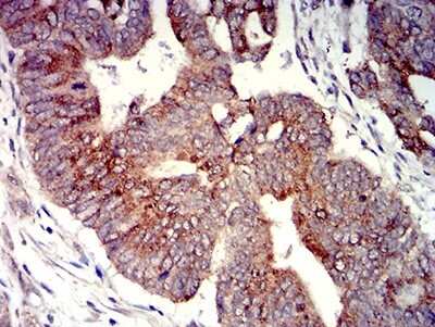 Immunohistochemistry: P2Y4/P2RY4 Antibody (3B4C11) [NBP2-61759] - Analysis of paraffin-embedded rectum cancer tissues using P2RY4 mouse mAb with DAB staining.