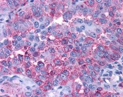 Immunohistochemistry-Paraffin: P2Y4/P2RY4 Antibody [NLS5011] - Analysis of anti-P2RY4 / P2Y4 antibody with human lung, non-small cell carcinoma.