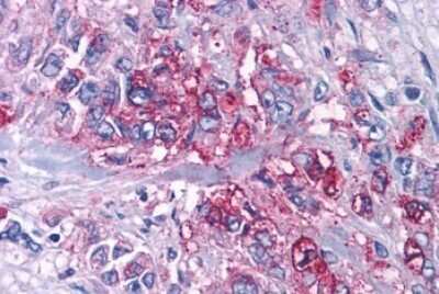 Immunohistochemistry-Paraffin: P2Y4/P2RY4 Antibody [NLS5011] - Anti-P2RY4 / P2Y4 antibody IHC of human Pancreas, Carcinoma. Immunohistochemistry of formalin-fixed, paraffin-embedded tissue after heat-induced antigen retrieval.