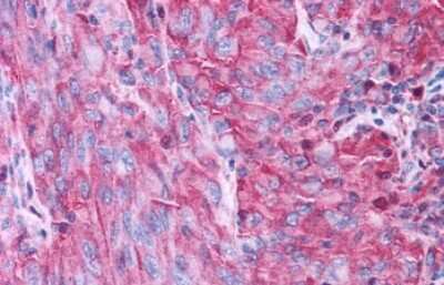 Immunohistochemistry-Paraffin: P2Y4/P2RY4 Antibody [NLS5011] - Anti-P2RY4 / P2Y4 antibody IHC of human Skin, Melanoma. Immunohistochemistry of formalin-fixed, paraffin-embedded tissue after heat-induced antigen retrieval.