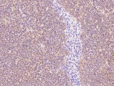 Immunohistochemistry-Paraffin: P2Y6/P2RY6 Antibody [NBP2-99485] - Immunochemical staining of human P2Y6/P2RY6 in human ovarian cancer with rabbit polyclonal antibody at 1:1000 dilution, formalin-fixed paraffin embedded sections.