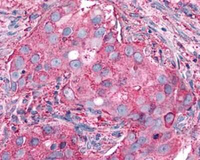 Immunohistochemistry-Paraffin: P2Y6/P2RY6 Antibody [NLS2726] - Analysis of anti-P2RY6 / P2Y6 antibody with human breast, carcinoma.