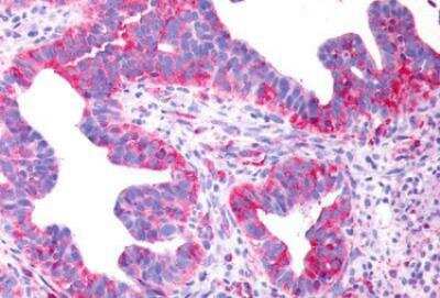 Immunohistochemistry-Paraffin: P2Y8 Antibody [NLS1921] - IHC of human Ovary, Carcinoma. Immunohistochemistry of formalin-fixed, paraffin-embedded tissue after heat-induced antigen retrieval.