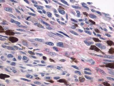 Immunohistochemistry-Paraffin: P2Y9 Antibody [NLS871] - Analysis of anti-P2Y9 antibody with melanoma.