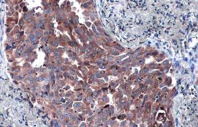 Immunohistochemistry-Paraffin: P4HA1 Antibody [NBP2-19664] -  Human lung cancer. P4HA1 stained by P4HA1 antibody [C1C3] diluted at 1:1000.Antigen Retrieval: Citrate buffer, pH 6.0, 15 min. 