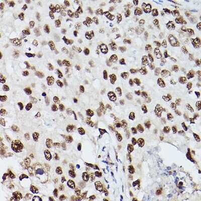 Immunohistochemistry-Paraffin: PA28 Activator gamma Subunit/PSME3 Antibody [NBP2-93183] - Immunohistochemistry of paraffin-embedded human breast cancer using PA28 Activator gamma Subunit/PSME3 Rabbit pAb (NBP2-93183) at dilution of 1:100 (40x lens). Perform microwave antigen retrieval with 10 mM PBS buffer pH 7.2 before commencing with IHC staining protocol.