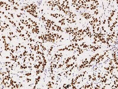 Immunohistochemistry-Paraffin: PA28 Activator gamma Subunit/PSME3 Antibody [NBP3-00357] - Immunochemical staining of human PA28 Activator gamma Subunit/PSME3 in human breast carcinoma with rabbit polyclonal antibody at 1:10000 dilution, formalin-fixed paraffin embedded sections.