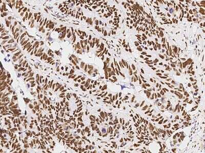 Immunohistochemistry-Paraffin: PA28 Activator gamma Subunit/PSME3 Antibody [NBP3-00357] - Immunochemical staining of human PA28 Activator gamma Subunit/PSME3 in human colon carcinoma with rabbit polyclonal antibody at 1:10000 dilution, formalin-fixed paraffin embedded sections.