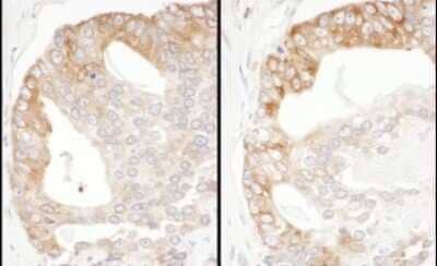 <b>Independent Antibodies Validation and Biological Strategies Validation.</b>Immunohistochemistry-Paraffin: PA2G4/EBP1 Antibody [NBP1-71840] - Human prostate carcinoma. Antibody: Affinity purified rabbit anti- EBP1 used at a dilution of 1:200 (1ug/ml). Detection: DAB. Counterstain: hematoxylin (blue).