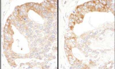 Immunohistochemistry-Paraffin: PA2G4/EBP1 Antibody [NBP1-71839] - FFPE serial sections of human prostate carcinoma. Antibody: Affinity purified rabbit anti-EBP1, left image and , right image used at a dilution of 1:200 (1 ug/ml). Detection: DAB. Counterstain: hematoxylin (blue).