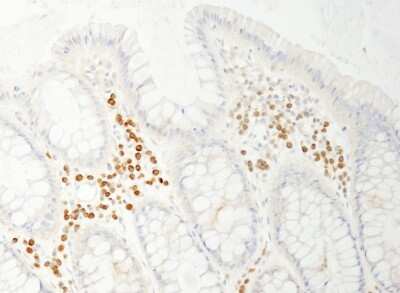 Immunohistochemistry-Paraffin: PABPC4 Antibody [NB100-74594] - Sample: FFPE section of human colon carcinoma. Antibody: Affinity purified rabbit anti- PABP4 used at a dilution of 1:200 (1ug/ml). Detection: DAB