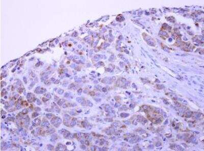 Immunohistochemistry-Paraffin: PACSIN1 Antibody [NBP1-32324] -  Paraffin-embedded MCF7 xenograft. PACSIN1 antibody  dilution: 1:500.