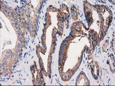 Immunohistochemistry: PACSIN3 Antibody (OTI4F8) - Azide and BSA Free [NBP2-73221] - Staining of paraffin-embedded Carcinoma of Human prostate tissue using anti-PACSIN3 mouse monoclonal antibody.
