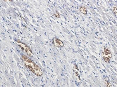 Immunohistochemistry-Paraffin: PACSIN3 Antibody (S04-1F1) [NBP3-19817] - Immunohistochemistry of PACSIN3 in paraffin-embedded Human colon cancer tissue using NBP3-19817 at dilution 1/50
