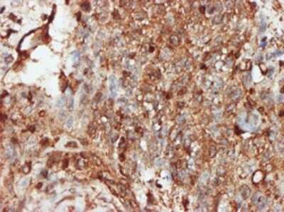 Immunohistochemistry-Paraffin: PACT Antibody (1B9-1A7) [H00008575-M01] - Analysis of monoclonal antibody to PRKRA on formalin-fixed paraffin-embedded human squamous cell carcinoma. Antibody concentration 5 ug/ml.