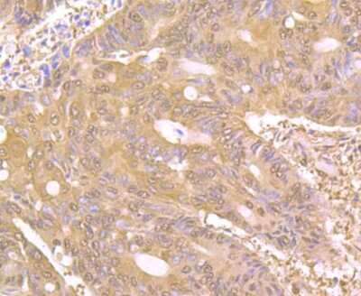 Immunohistochemistry-Paraffin: PAK2 Antibody (JB41-84) [NBP2-75607] - Analysis of paraffin-embedded human colon cancer tissue using anti-PAK2 antibody. Counter stained with hematoxylin.