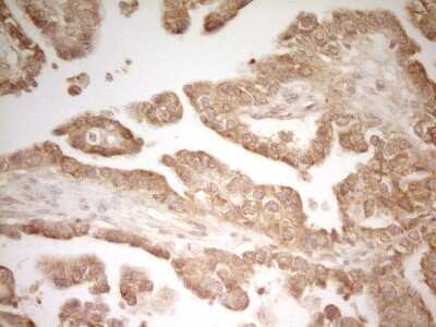 Immunohistochemistry: PAK4 Antibody (1C7) [NBP2-46316] - Analysis of Adenocarcinoma of Human ovary tissue. (Heat-induced epitope retrieval by 1 mM EDTA in 10mM Tris, pH8.5, 120C for 3min)