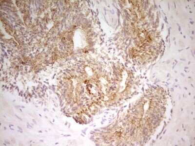 Immunohistochemistry: PAK4 Antibody (1C7) [NBP2-46316] - Analysis of Human prostate tissue. (Heat-induced epitope retrieval by 1 mM EDTA in 10mM Tris, pH8.5, 120C for 3min)