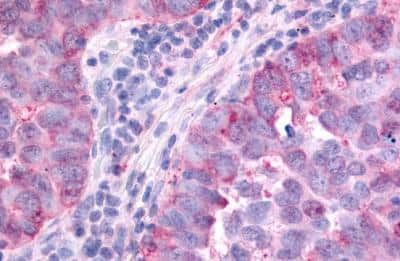 Immunohistochemistry-Paraffin: PAK6 Antibody [NLS6942] - Human Lung, Non-Small Cell Carcinoma. formalin-fixed, paraffin-embedded tissue after heat-induced antigen retrieval.