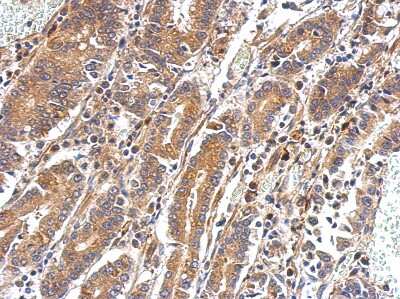 Immunohistochemistry-Paraffin: PAPSS2 Antibody [NBP1-33726] - Paraffin-embedded Colon ca, using antibody at 1:200 dilution.