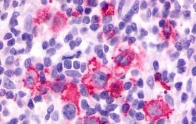 Immunohistochemistry-Paraffin: PAR4 Antibody [NLS1309] - Anti-F2RL3 / PAR4 antibody IHC of human Lymph Node, Hodgkins Lymphoma tissue after heat-induced antigen retrieval.
