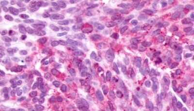 Immunohistochemistry-Paraffin: PAR4 Antibody [NLS1309] - Anti-F2RL3 / PAR4 antibody IHC of human Ovary, Carcinoma tissue after heat-induced antigen retrieval.