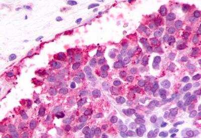 Immunohistochemistry-Paraffin: PAR4 Antibody [NLS1309] - Ovary, carcinoma