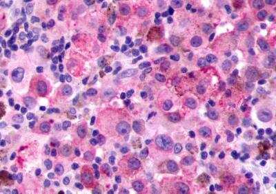 Immunohistochemistry-Paraffin: PAR4 Antibody [NLS1309] - Skin, Malignant Melanoma