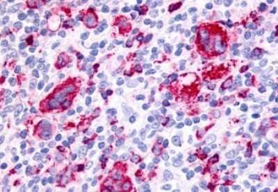Immunohistochemistry-Paraffin: PAR4 Antibody [NLS1310] - Anti-F2RL3 / PAR4 antibody IHC of human Lymph Node, Hodgkins Lymphoma. Immunohistochemistry of formalin-fixed, paraffin-embedded tissue after heat-induced antigen retrieval.