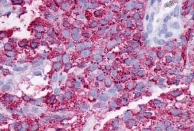 Immunohistochemistry-Paraffin: PAR4 Antibody [NLS1310] - Anti-F2RL3 / PAR4 antibody IHC of human Ovary, Carcinoma. Immunohistochemistry of formalin-fixed, paraffin-embedded tissue after heat-induced antigen retrieval.