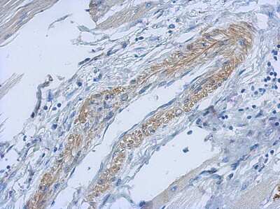 Immunohistochemistry-Paraffin: PARD6B Antibody [NBP2-19695] - Immunohistochemical analysis of paraffin-embedded Gastric ca, using antibody at 1:500 dilution.