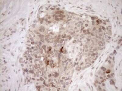 Immunohistochemistry-Paraffin: PARG Antibody (OTI6F4) [NBP2-46320] - Analysis of Adenocarcinoma of Human endometrium tissue. (Heat-induced epitope retrieval by 1mM EDTA in 10mM Tris buffer (pH8.5) at 120C for 3 min)