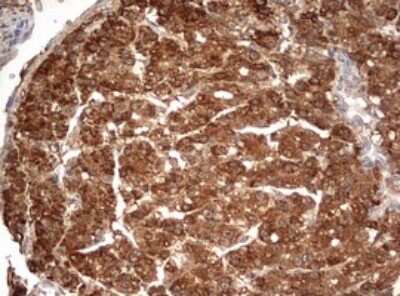 Immunohistochemistry: PARN Antibody (4D12) [NBP2-46321] - Analysis of Carcinoma of Human liver tissue.(Heat-induced epitope retrieval by 10mM citric buffer, pH6.0, 120C for 3min)