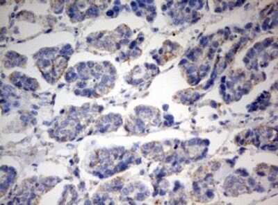 Immunohistochemistry: PARN Antibody (4D12) [NBP2-46321] - Analysis of Carcinoma of Human bladder tissue. (Heat-induced epitope retrieval by 10mM citric buffer, pH6.0, 120C for 3min)