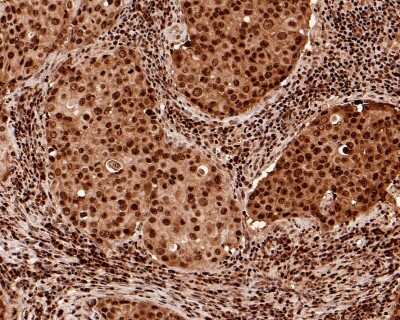 Immunohistochemistry-Paraffin: PARP Antibody (SU03-68) [NBP2-67482] - Analysis of paraffin-embedded human breast carcinoma tissue with Rabbit anti-PARP antibody washed with ddH2O and PBS, and then probed with the primary antibody  at 1/500 dilution for 1 hour at room temperature. The detection was performed using an HRP conjugated compact polymer system. DAB was used as the chromogen. Tissues were counterstained with hematoxylin and mounted with DPX.