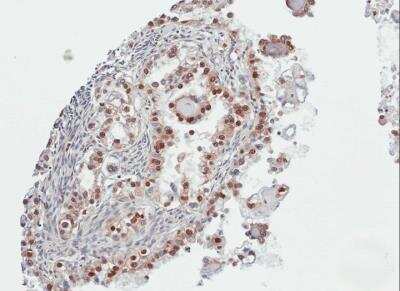 Immunohistochemistry-Paraffin: PARP3 Antibody [NBP1-31415] - Paraffin-embedded OVCA, using antibody at 1:100 dilution.