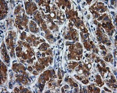 Immunohistochemistry-Paraffin: PASK Antibody (8G9) [NBP2-02242] - Staining of paraffin-embedded Carcinoma of Human liver tissue using anti-PASK mouse monoclonal antibody.