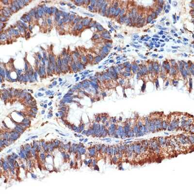 Immunohistochemistry-Paraffin: PAWR / PAR4 Antibody (10Q2G9) [NBP3-16523] - Immunohistochemistry of paraffin-embedded human colon carcinoma using PAWR / PAR4 Rabbit mAb (NBP3-16523) at dilution of 1:100 (40x lens).Perform microwave antigen retrieval with 10 mM Tris/EDTA buffer pH 9.0 before commencing with IHC staining protocol.