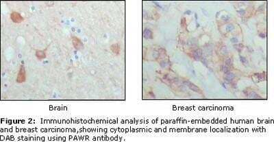 Immunohistochemistry-Paraffin: PAWR / PAR4 Antibody (3G9H7) [NBP1-28892] - Analysis of human brain (left) and breast carcinoma (right), showing cytoplasmic and membrane localization using PAR4 mouse mAb  with DAB staining.