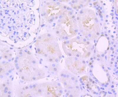 Immunohistochemistry-Paraffin: PAX8 Antibody (JJ08-88) [NBP2-67876] - Analysis of paraffin-embedded human ovarian cancer tissue using anti-PAX8 antibody. Counter stained with  hematoxylin.