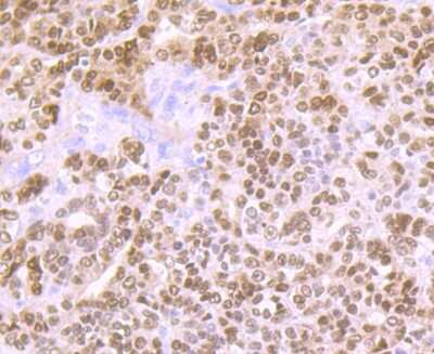 Immunohistochemistry-Paraffin: PAX8 Antibody (JJ08-88) [NBP2-67876] - Immunohistochemical analysis of paraffin-embedded human ovarian carcinoma tissue using anti-PAX8 antibody. The section was pre-treated using heat mediated antigen retrieval with Tris-EDTA buffer (pH 8.0-8.4) for 20 minutes. The tissues were blocked in 5% BSA for 30 minutes at room temperature, washed with ddH2O and PBS, and then probed with the primary antibody (1/50) for 30 minutes at room temperature. The detection was performed using an HRP conjugated compact polymer system. DAB was used as the chromogen. Tissues were counterstained with hematoxylin and mounted with DPX.