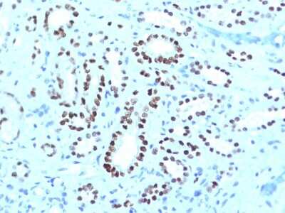 Immunohistochemistry-Paraffin: PAX8 Antibody (PAX8/1491 + PAX8/1492) - Azide and BSA Free [NBP3-08274] - Formalin-fixed, paraffin-embedded human Renal Cell Carcinoma stained with PAX8 Monoclonal Antibody (PAX8/1491 + PAX8/1492).